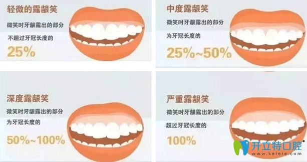 露齦笑可以矯正嗎？公布露齦笑手術費用及矯正前后對比照