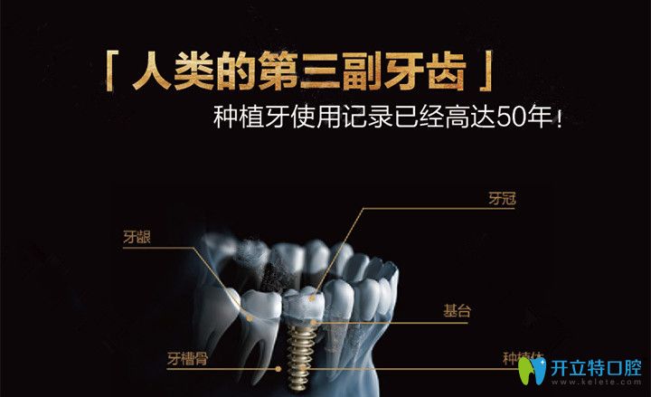 深圳好佰年種植牙技術(shù)