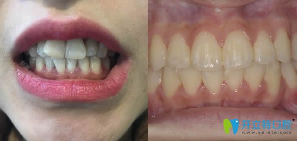臺州維多利亞口腔隱形正畸效果對比圖