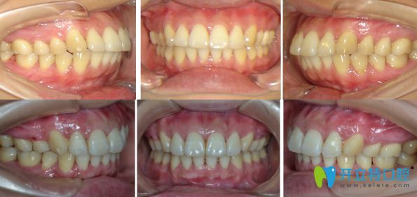 牙齒前突活動(dòng)翼矯正前后對(duì)比圖