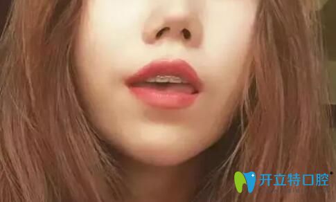 戴半隱形牙套矯正齙牙過程中