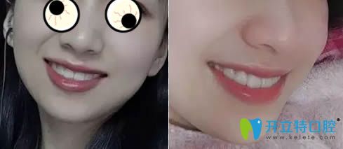 在廣州華美戴隱適美牙套第8個月效果