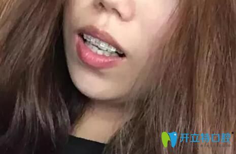 梅州愛麗諾口腔陶瓷半隱形矯正天戴牙套