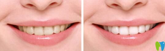 梅州哪家做牙齒美白效果好？愛麗諾牙齒冷光美白效果公布