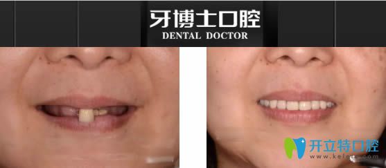 寧波牙博士全口種植牙真實<span style=