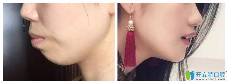 突嘴齙牙矯正前后對比照