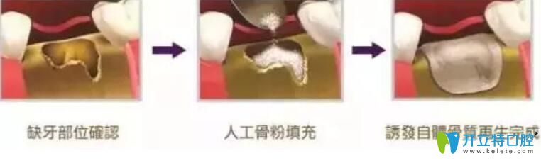 骨粉是個(gè)什么東西？為什么種牙要植骨粉