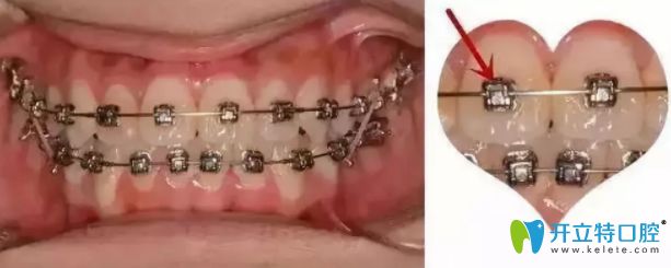 干貨：牙齒矯正托槽掉了怎么辦？托槽掉了必須馬上粘嗎?