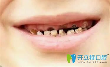 嚴重的奶瓶齲齒癥狀圖