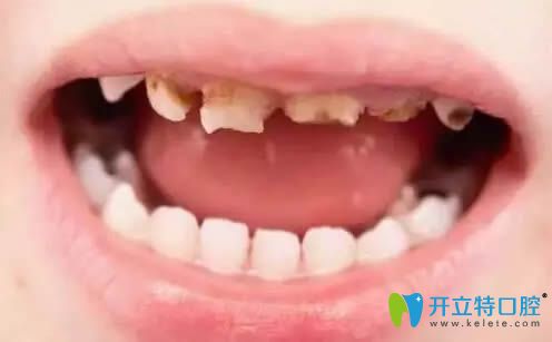 奶瓶齲早期圖片