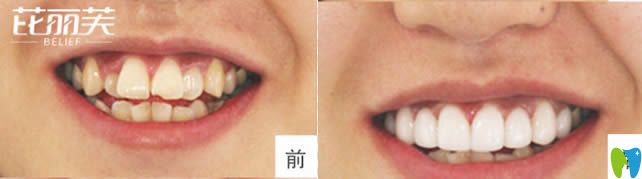 金華芘麗芙口腔矯正虎牙前后對(duì)比效果 金華芘麗芙口腔矯正虎牙前后對(duì)比效果