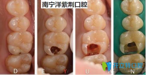 <!--<i data=20240703-sp></i>-->口腔覃琨醫(yī)生根管治療案例對(duì)比圖