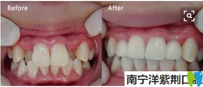 兒童虎牙矯正前后對(duì)比效果