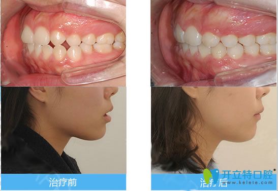 長(zhǎng)春欣雅口腔林曦院長(zhǎng)隱形矯正對(duì)比效果及臉型變化圖