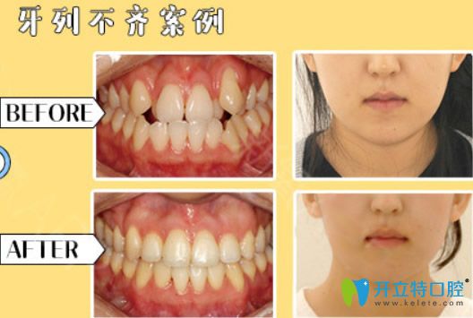 金華芘麗芙口腔青少年牙列不齊矯正后對比照