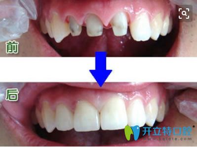 烤瓷牙修復(fù)前后對比照片
