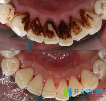 長春欣雅口腔李國民醫(yī)生洗牙前后對比效果