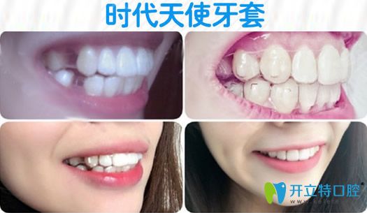 金華芘麗芙成年人時代天使隱形矯正對比效果