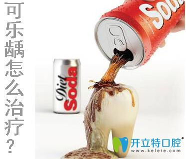求問可樂齲怎么治療？專業(yè)解答可樂牙的治療費用和方法