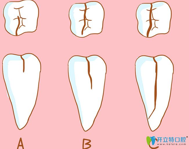 才22歲牙齒就隱裂了，深究牙齒開裂是什么原因造成的？