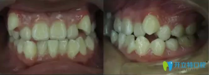 安氏Ⅲ類錯頜矯正術(shù)前照