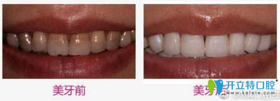惠州致美口腔好不好？看致美口腔賴健美牙齒冷光美白案例效果對比圖