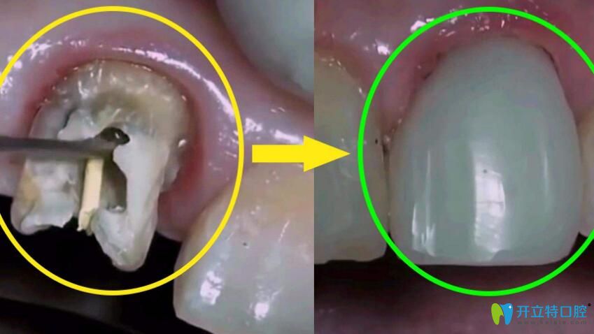 牙齒碎裂后該怎么辦呢？有哪些方法可以補(bǔ)救