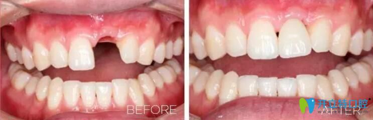 深圳哪家種植牙好？諾德齒科單顆牙種植案例一覽