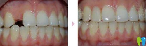 保定合眾口腔種植前后效果圖