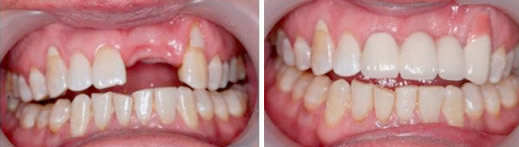 對比活動(dòng)假牙和種植牙后決定在深圳好佰年口腔做即刻種植