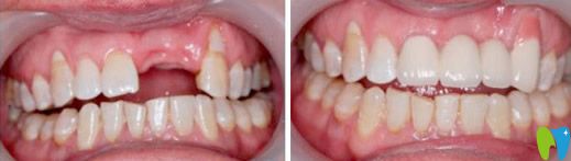 即刻種植牙前后對比圖