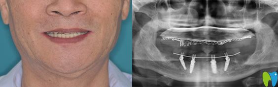 林大爺在佛山智媄口腔做全口種植牙后照片 林大爺在佛山智媄口腔做全口種植牙后照片