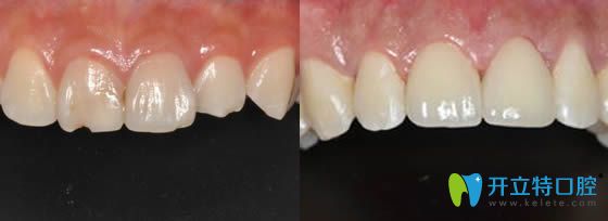 無錫北極星口腔姚凱牙體修復效果對比圖
