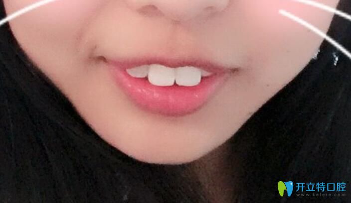 門牙太大太長(zhǎng)能磨小嗎？有沒有門牙被磨后的對(duì)比照片？