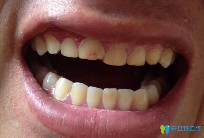 門牙太大、太長可以磨小嗎