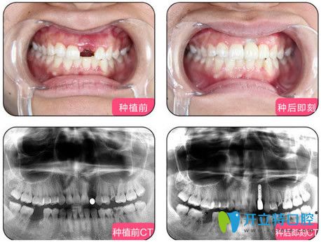烏魯木齊凱樂(lè)口腔單顆種植牙效果圖