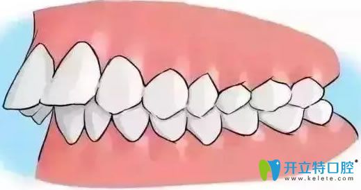 聽說門牙突出能自我糾正,牙齒外突可以用手按回去嗎？