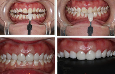 保定合眾口腔做全瓷牙案例公布