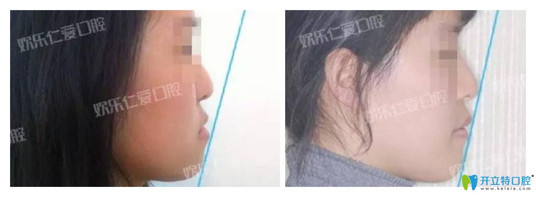 沈陽歡樂口腔怎么樣？肖春正畸案例公布