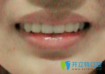 我在長春陳北松口腔戴烤瓷牙套當(dāng)天