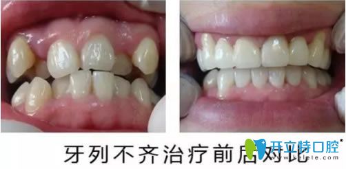 壹加壹戚志鋒主任隱適美牙齒矯正前后對(duì)比照