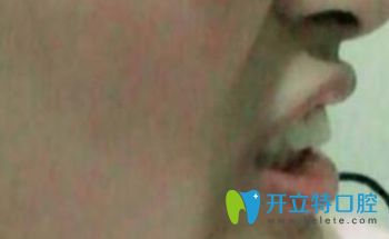 我在長春陳北松口腔做烤瓷牙矯正一個月