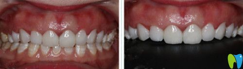 全瓷貼面后牙齒效果圖