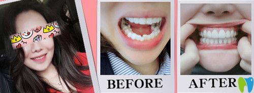 東莞哪里矯正牙齒好？東莞好百年口腔牙齒不齊矯正案例來(lái)證明