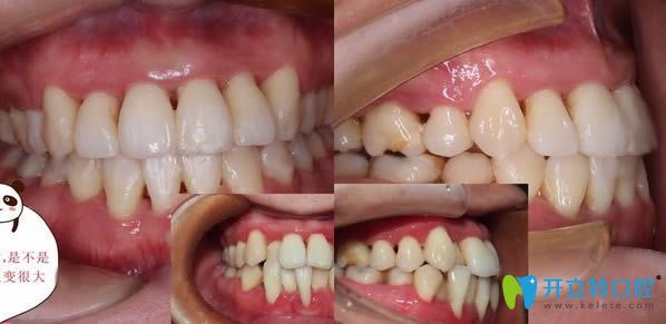 廈門登特口腔隱形牙齒矯正前后效果對(duì)比圖