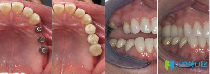 弘和口腔多顆牙缺失及單顆牙缺失種植前后對比圖