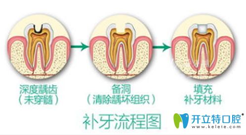 牙齒做根管治療和補牙有什么區(qū)別