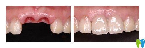 東莞好佰年口腔牛海濤門牙缺失種植案例