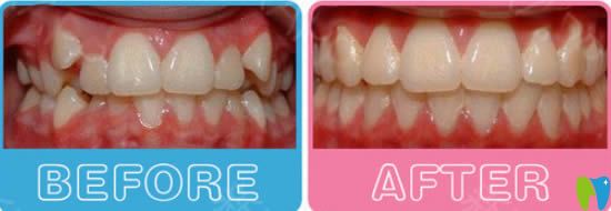 武漢清華陽光口腔牙齒擁擠+虎牙矯正后對(duì)比照