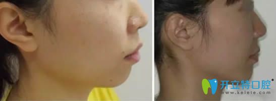 深覆合矯正后臉型變化對比效果圖